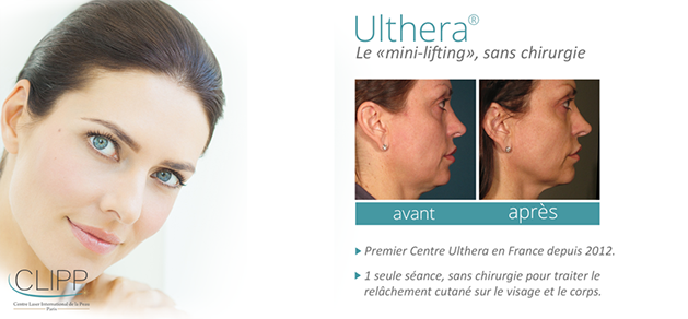 ulthera temoignage ulratons visage paris