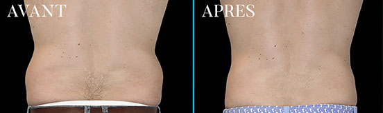 cryolipolyse emsculpt paris 