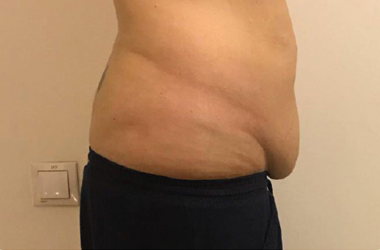 Traiter le relâchement abdominal post-grossesse avec l'Exilis au CLIPP à  Paris - Centre Laser CLIPP