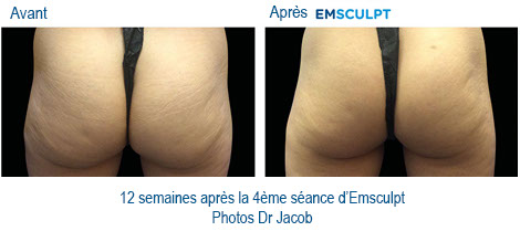 emsculpt avis paris négatif