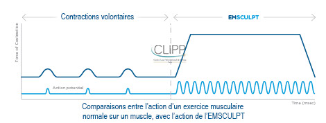 emsculpt paris avis 