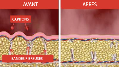 capitons solution cellulite sans chirurgie paris 