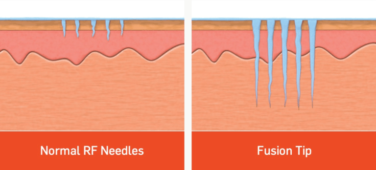 radiofrequence visage corps paris microneedling médecine esthétique