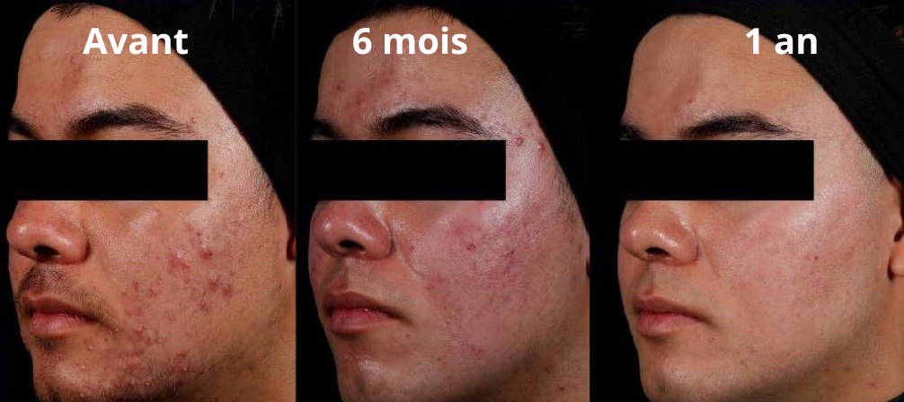 AviClear Laser Pour L acn Centre Laser CLIPP aviclear-laser-pour-l-acn-centre-laser-clipp