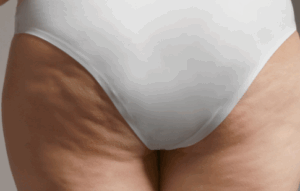 traitement de la cellulite paris centre laser